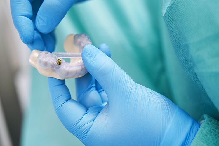 Clínica Dental Andrea Compte, tu Centro Odontológico especializado. Implantes dentales (Implantología) en Alcossebre. Doctor sosteniendo un modelo de dentadura con implante en sus manos.
