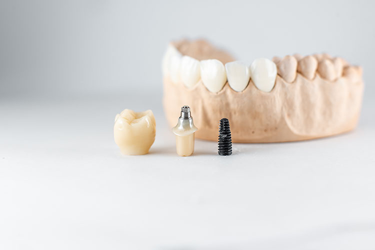 Clínica Dental Andrea Compte, tu Centro Odontológico especializado. Implantes dentales (Implantología) en Alcossebre. Modelo de mandíbula artificial e implante dental.