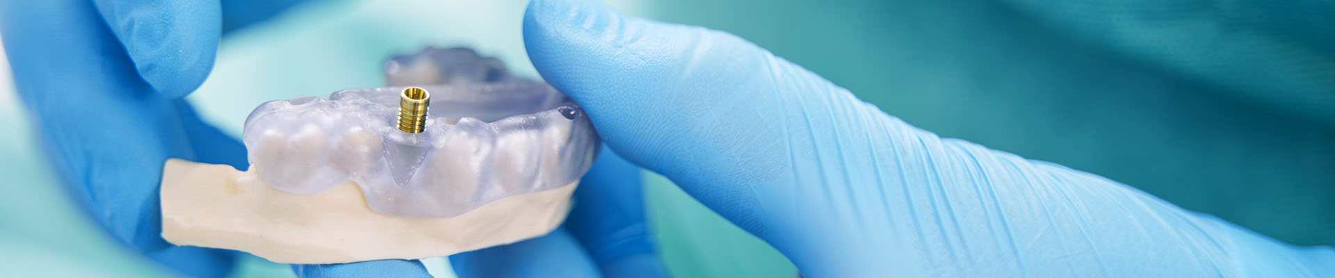 Clínica Dental Andrea Compte, tu Centro Odontológico especializado. Implantes dentales (Implantología) en Cálig. Dentista sosteniendo modelo de dientes con implante dental.