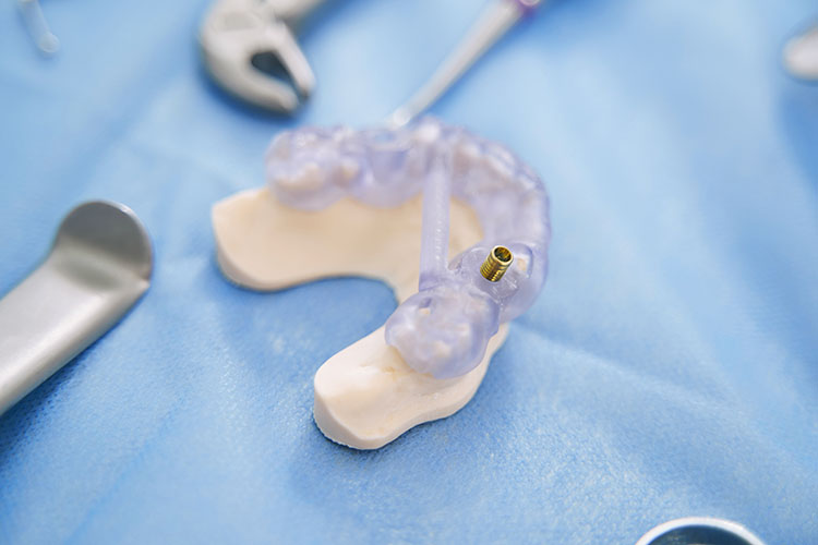 Clínica Dental Andrea Compte, tu Centro Odontológico especializado. Implantes dentales (Implantología) en Santa Magdalena. Modelo de dientes con implante dental.