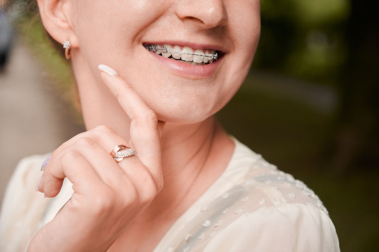 Clínica Dental Andrea Compte, tu Centro Odontológico especializado. Ortodoncia en Alcalá de Xivert. Mujer sonriendo con ortodoncia en los dientes.
