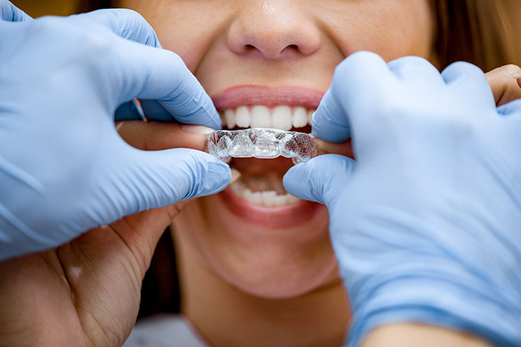 Clínica Dental Andrea Compte, tu Centro Odontológico especializado. Ortodoncia en Alcossebre. Dentista poniendo a la paciente los aparatos invisibles.