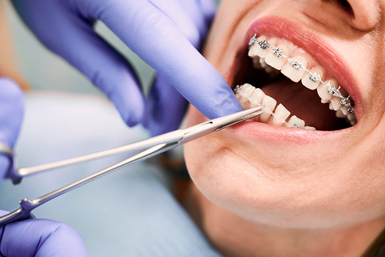 Clínica Dental Andrea Compte, tu Centro Odontológico especializado. Ortodoncia en Alcossebre. Ortodoncista colocando frenillos en los dientes de la paciente.