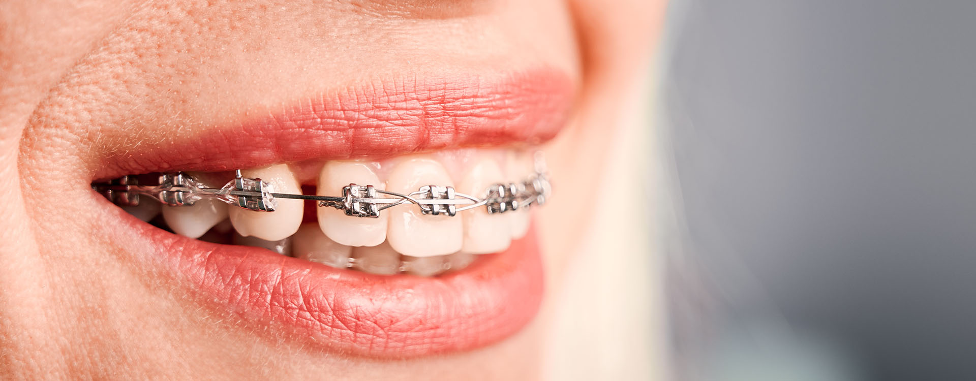 Clínica Dental Andrea Compte, tu Centro Odontológico especializado. Ortodoncia en Cálig. Sonrisa con brackets en los dientes.